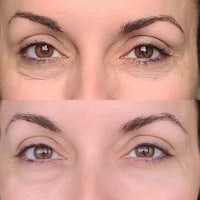 before and after pictures of a woman's eyes