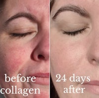 24 days collagen before and after