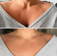 before and after pictures of a woman's neck